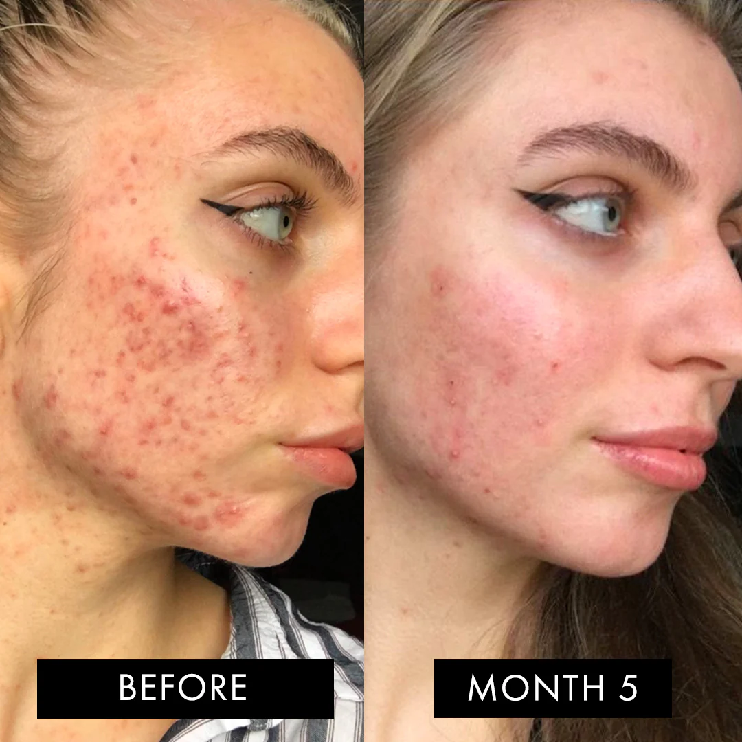 The Skin Elixir® Three Month Pack - Image 7